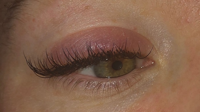 Allergic eyelash when using lash extension