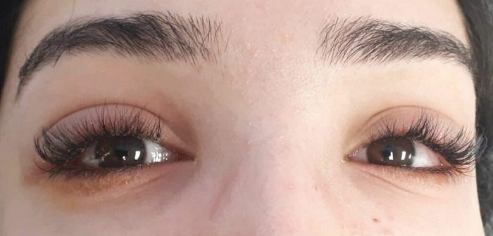 Allergic reaction is a common side effect from using eyelash glue