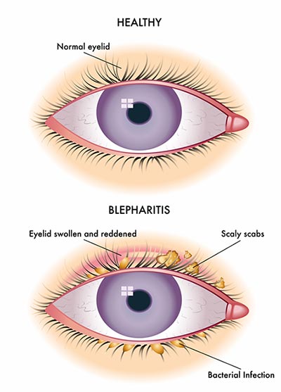 Blepharitis is an inflammatory condition affecting the eyelids
