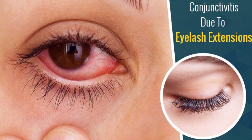 Eyelash extensions can cause some allergies for people with sensitive skin