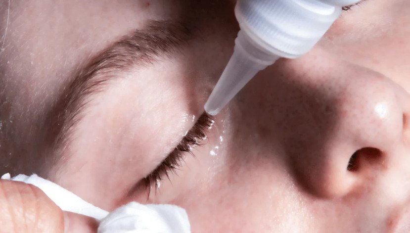 Lash glue allergy can be treated in different ways based on levels of reaction