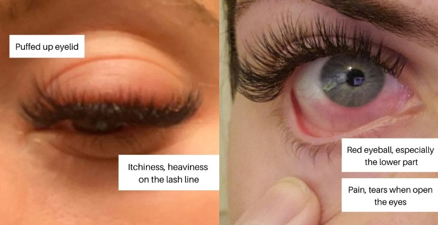 Swollen eyelids are the clearest symptom of lash glue allergy
