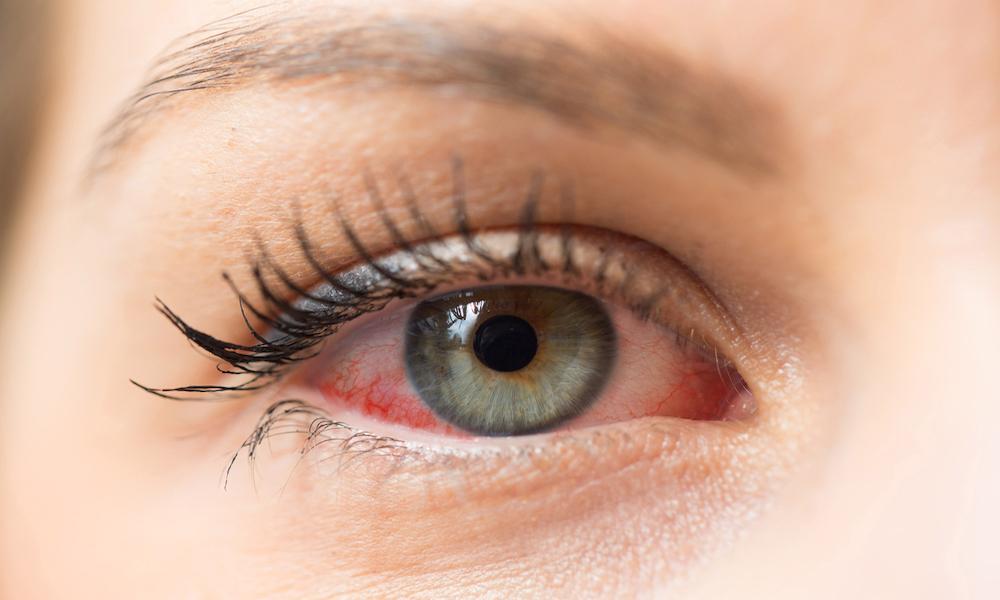 Opting for eyelash glues with gentle ingredients and avoiding irritants can help minimize issues of redness, inflammation, or a gritty feeling or even allergic