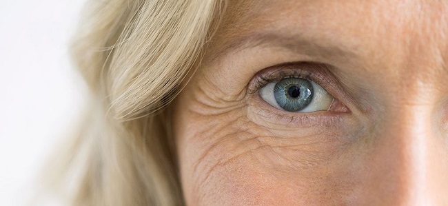 Aging is a cause of white eyelashes