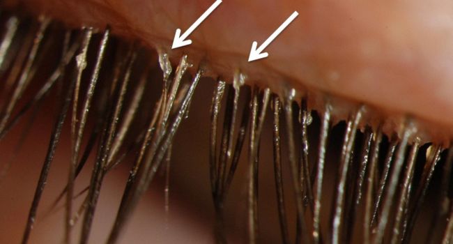 eyelash-mites