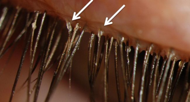 Eyelash Mites What Are They Causes Symptoms And Treatment 