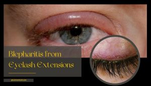 Blepharitis from Eyelash Extensions