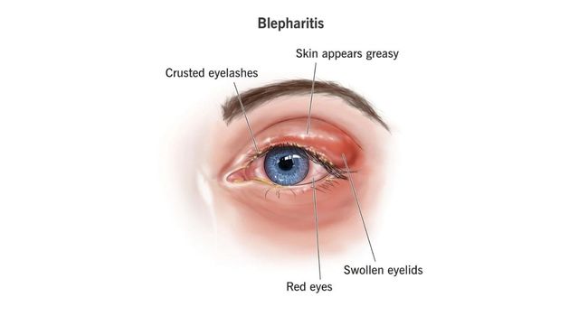 blepharitis-from-eyelash-extensions