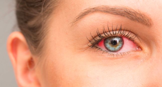 blepharitis-from-eyelash-extensions