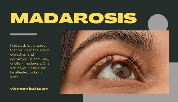 Madarosis is a disorder that results in the loss of eyelashes