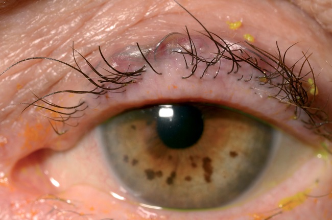 An ingrown eyelash grows inward toward the eye