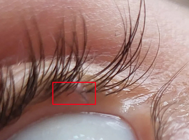 It can be very painful and irritating to have an ingrown eyelash