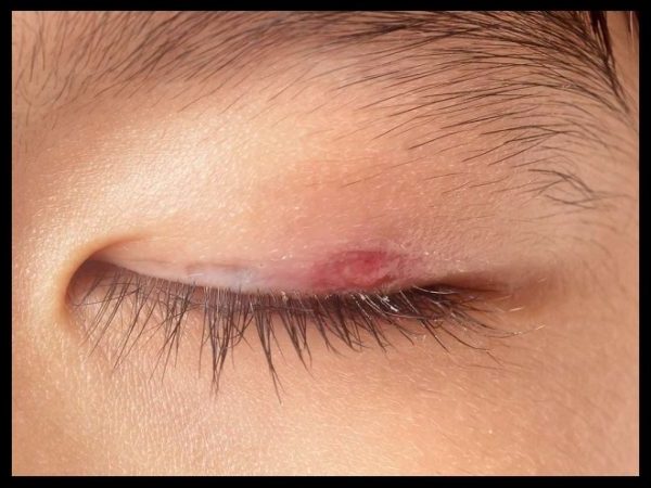 What Causes Ingrown Hair On Eyelid