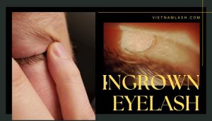 ingrown eyelash