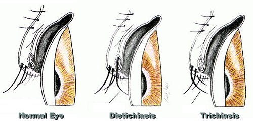 Being born with double eyelashes occurs with lymphedema-distichiasis syndrome