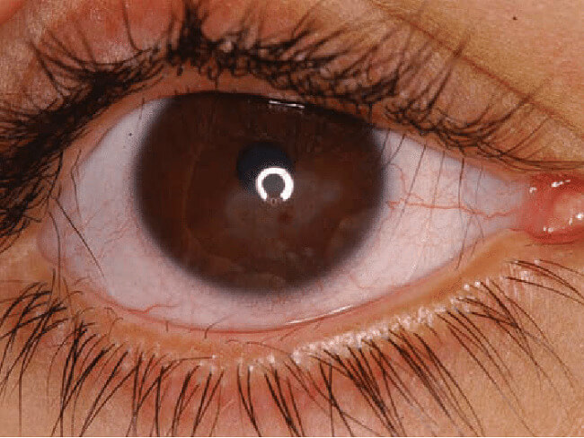Distichiasis is an uncommon eye disorder characterized by two rows of eyelashes