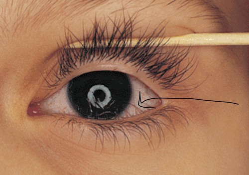 This type of double eyelashes might be caused by factors