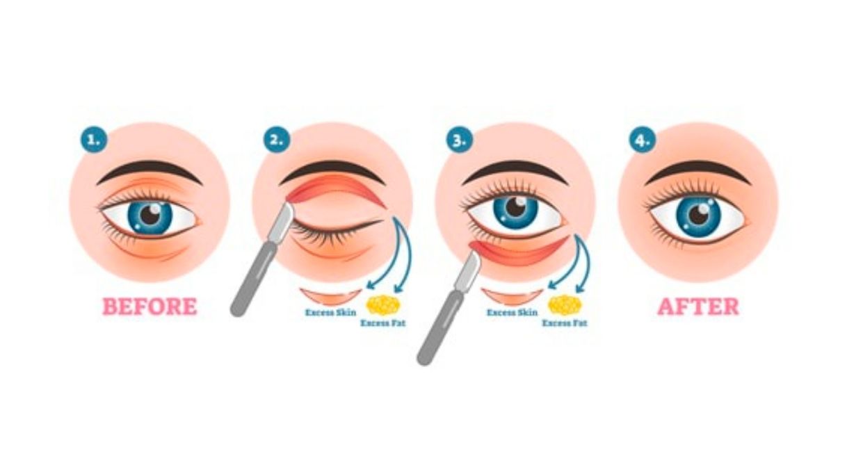 how to get rid of bags under eyes