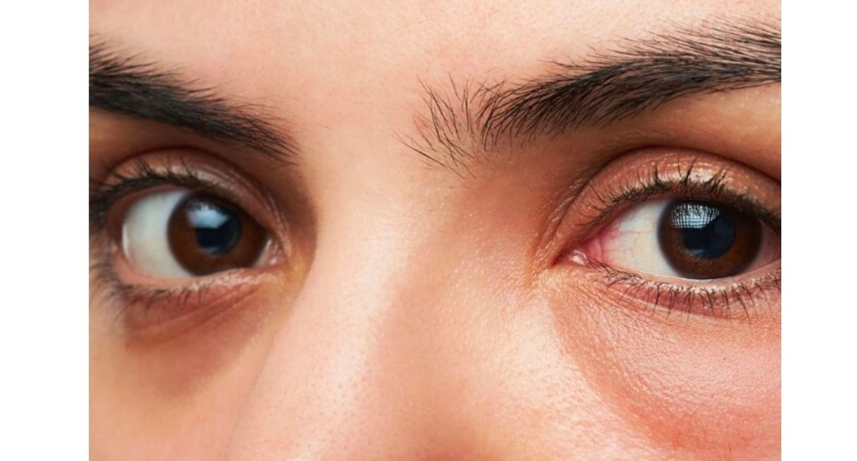 how to get rid of bags under eyes