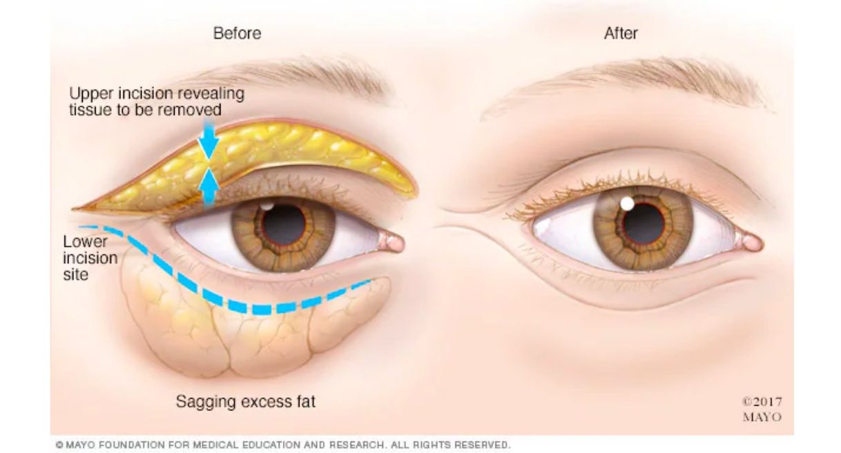 how to get rid of bags under eyes