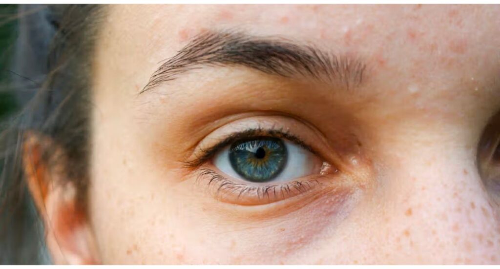 types of eyelids