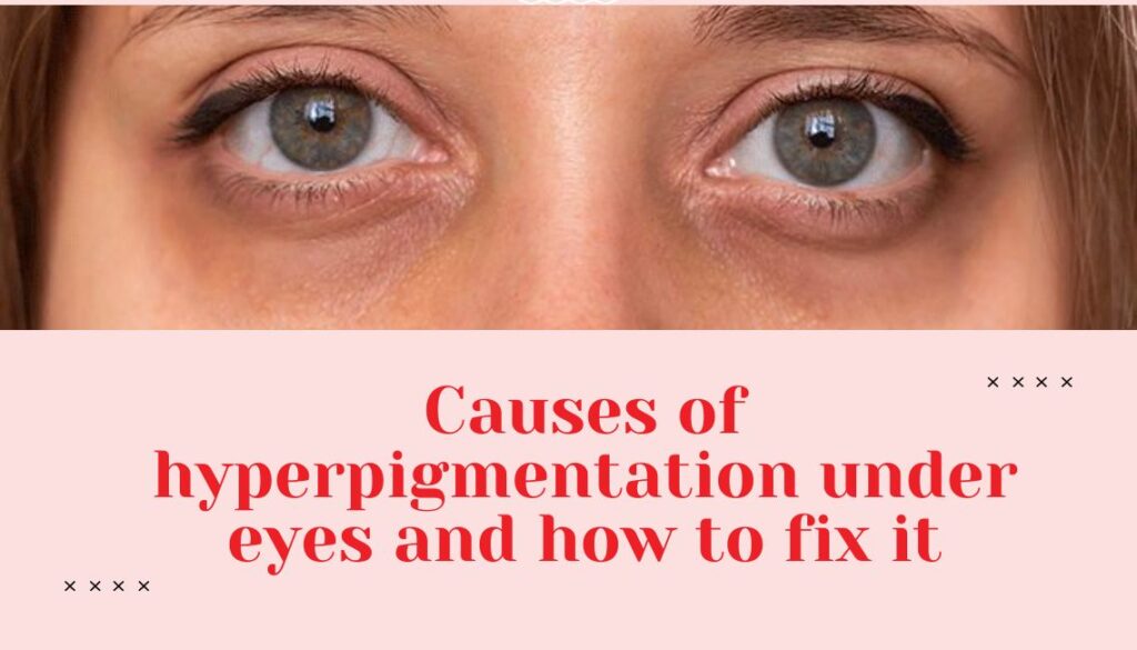 hyperpigmentation under eyes