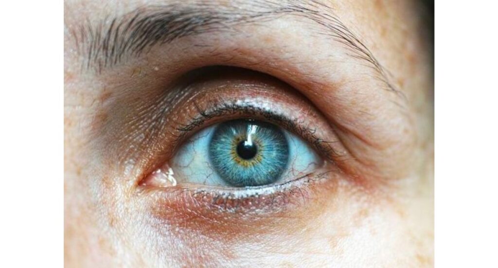 hyperpigmentation under eyes