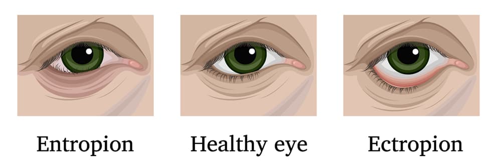 Ingrown Eyelash