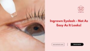 Ingrown Eyelash - Not As Easy As It Looks!