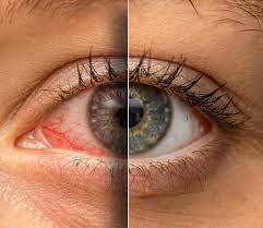 Red Eyes Be Gone! Conquer Red Eyes after Lash Extensions