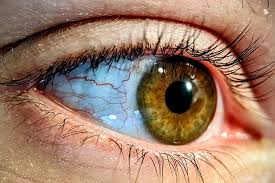 Red Eyes Be Gone