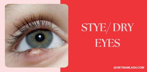 stye